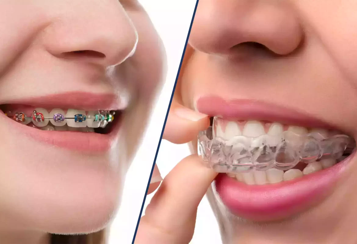 Invisalign vs. Traditional Braces: What's Best for You in Sydney?